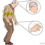 Hội chứng Parkinson có dấu hiệu gì?