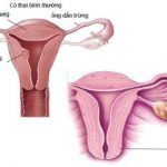 Mổ thai ngoài tử cung – tất tần tật những thông tin