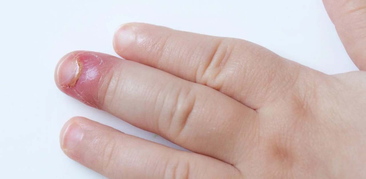 Cách xử lý khi đầu ngón tay bị sưng đỏ đau nhức đúng cách