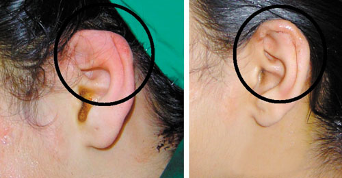 Cách chữa viêm sụn vành tai như thế nào?
