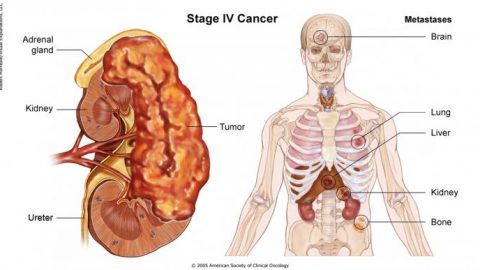 Ung thư gan giai đoạn cuối biểu hiện như thế nào?