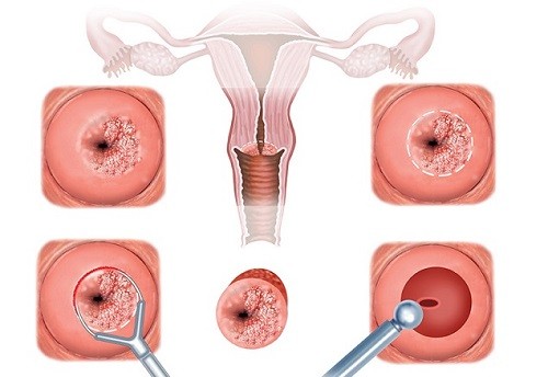 Quá trình đốt viêm lộ tuyến có gây đau đớn không?
