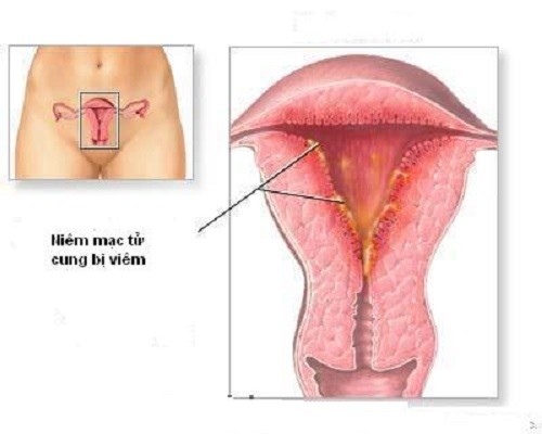 Viêm nội mạc tử cung sau khi hút thai | TCI Hospital