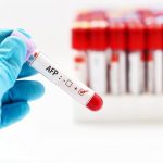 AFP – xét nghiệm quan trọng trong sàng lọc ung thư gan