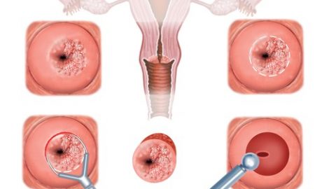 Xét nghiệm tế bào ung thư cổ tử cung là gì?