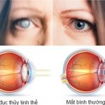 5 Bệnh về mắt thường gặp ở người già