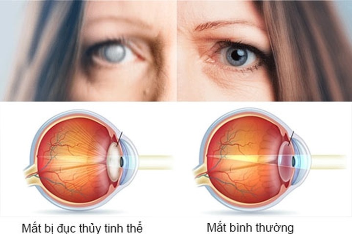 Tìm hiểu về các bệnh về mắt ở người cao tuổi và phương pháp chữa trị