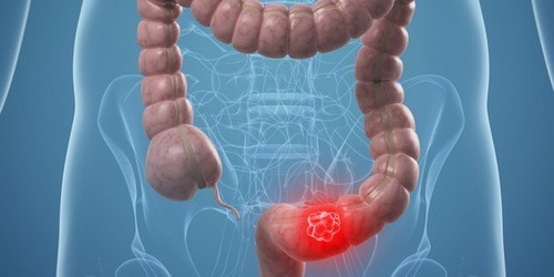 Đi ngoài ra máu có thể do polyp trực tràng