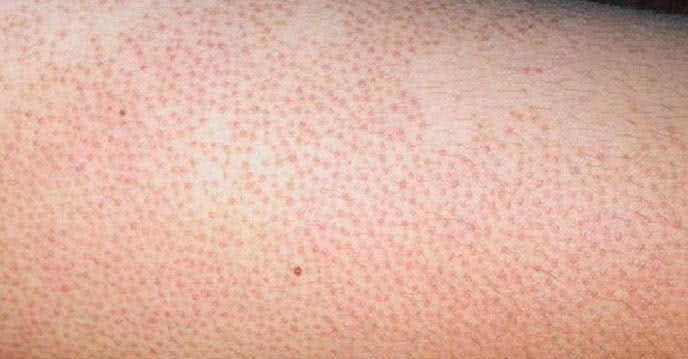 Nguyên nhân gây viêm lỗ chân lông