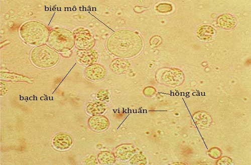 Bạch cầu trong nước tiểu khi mang thai nếu ở mức cho phép là dấu hiệu bình thường
