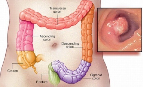 Có tác dụng phụ nào khi sử dụng thuốc điều trị polyp hậu môn không?
