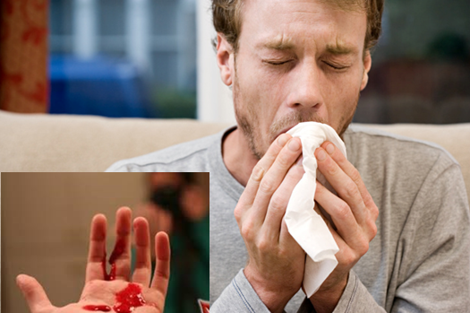 Triệu chứng sản phẩm đờm và nước mũi có máu là dấu hiệu của bệnh gì?