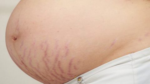 Hình ảnh rạn da khi mang thai biến chứng nguy hiểm