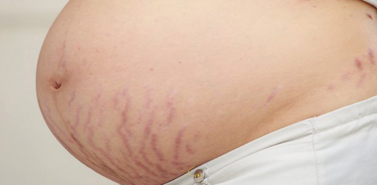 Rạn da khi mang bầu có thể ảnh hưởng đến sức khỏe của mẹ và thai nhi không?
