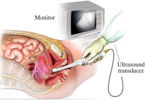 Siêu âm đầu dò có đau không? | TCI Hospital