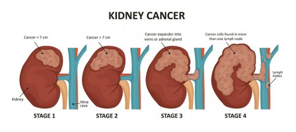 1. Khái quát về ung thư thận