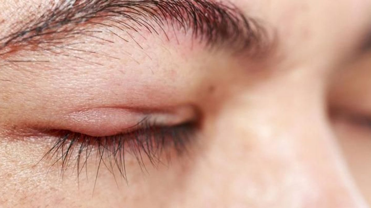 Cách chăm sóc và ứng phó với bị viêm bờ mi mắt kiêng ăn gì 