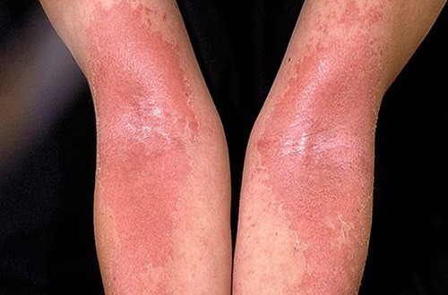 Bệnh eczema xuất hiện ở lứa tuổi nào?
