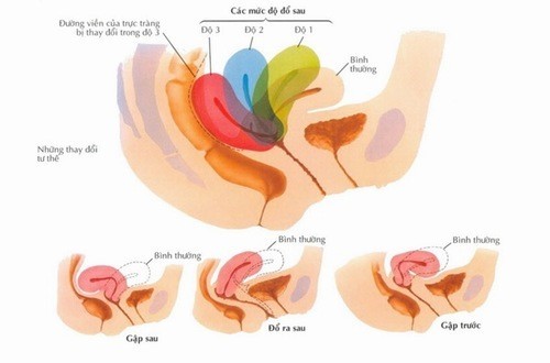 Hình ảnh tử cung bị sa: những cấp độ sa tử cung
