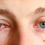 Sưng mí mắt là bệnh gì? Phải làm gì khi bị sưng mí mắt?