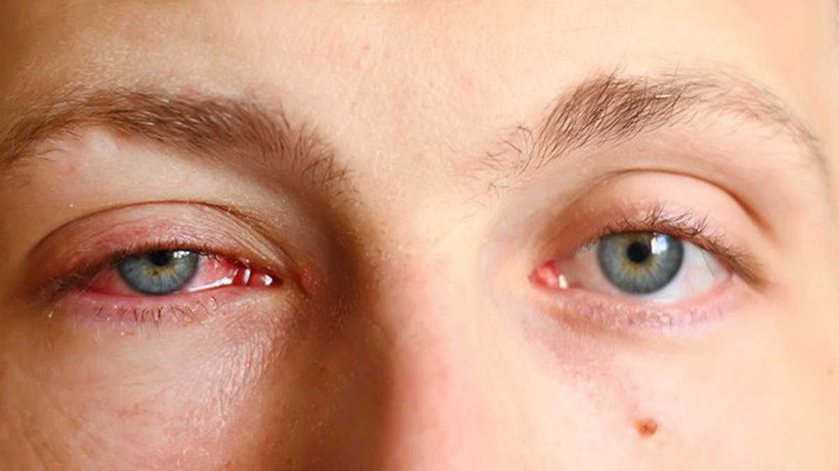 Làm cách nào để giảm sưng khóe mắt?
