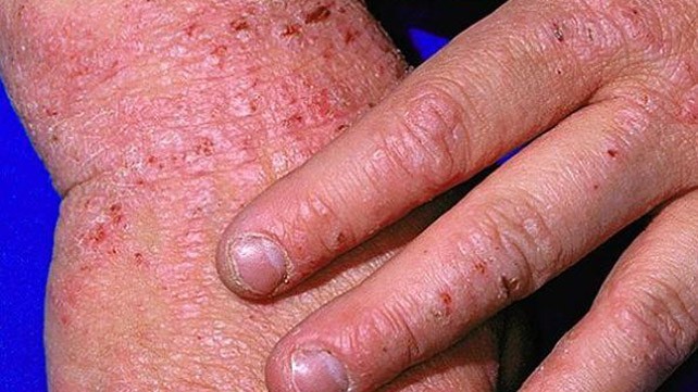 Các loại thuốc điều trị bệnh eczema hiện nay?

