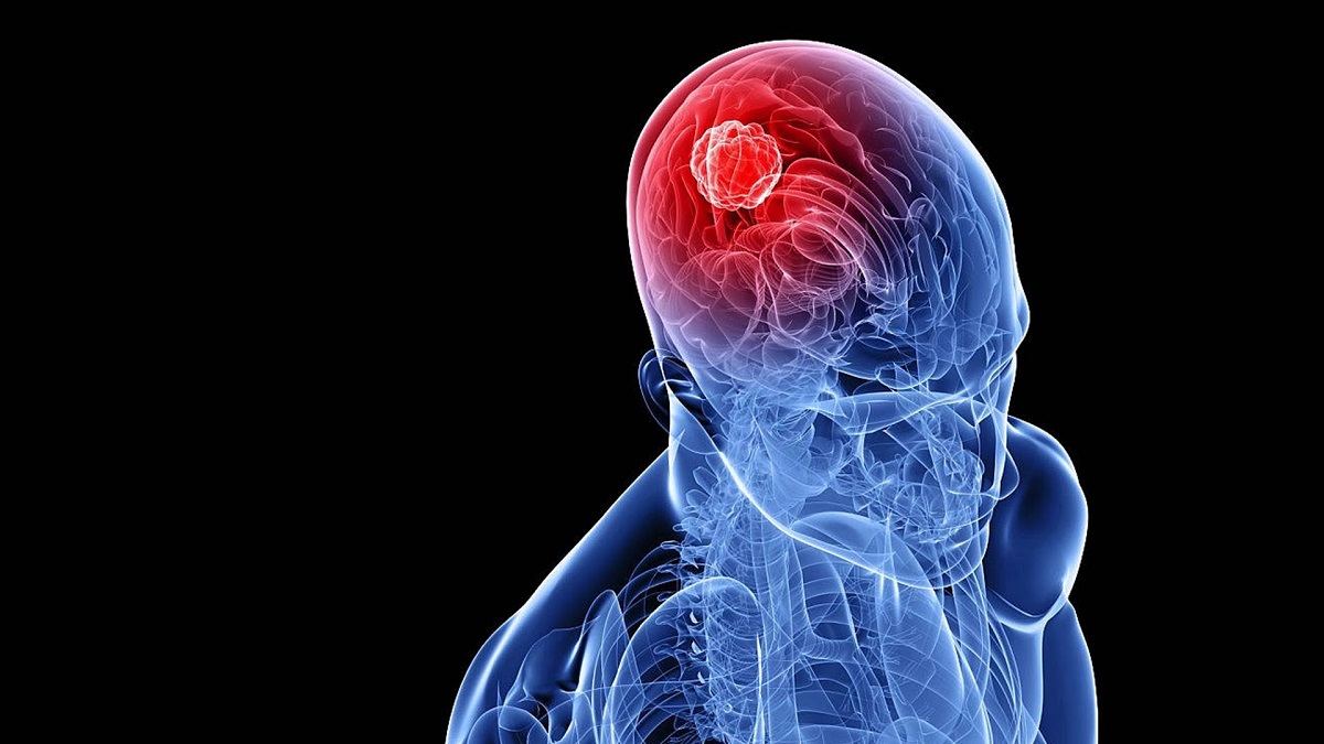 Mức độ nghiêm trọng của bệnh u não ảnh hưởng đến tuổi thọ?
