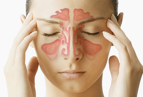 Người mắc bệnh viêm xoang thường có cảm giác đau nhức, chảy dịch, nghẹt mũi,...