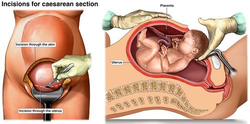 Có những yếu tố nào ảnh hưởng đến quá trình phục hồi sau sinh mổ?
