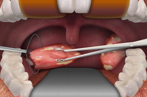Sau cắt amidan có hết viêm họng không? Câu trả lời là có thể vẫn bị viêm họng