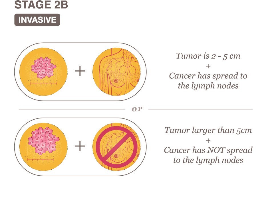 Ung thư vú giai đoạn 2B