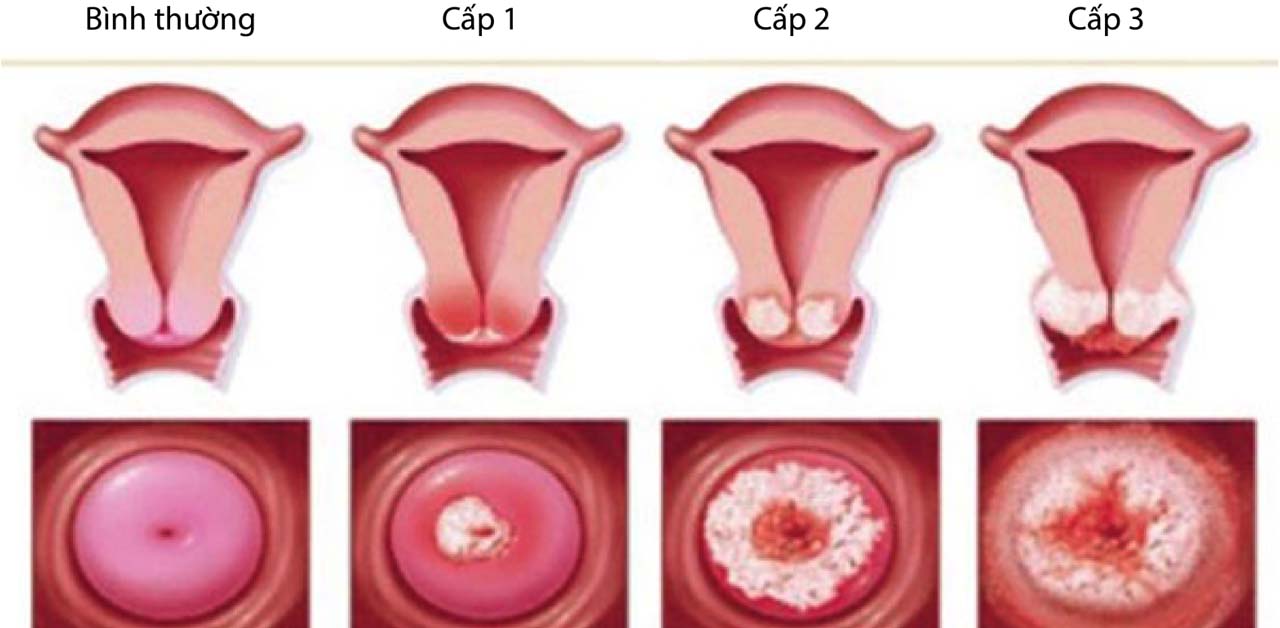 Có những yếu tố nào ảnh hưởng đến giá thành của việc đốt viêm lộ tuyến?
