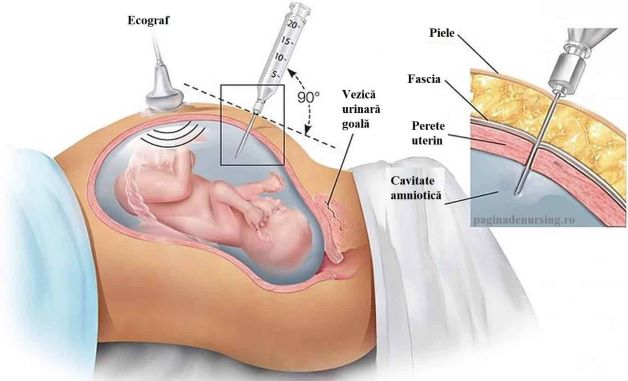 Bấm ối cũng có nguy cơ gây ra một số biến chứng. Mẹ bầu cần chọn bác sĩ và địa chỉ uy tín để thực hiện kỹ thuật này.