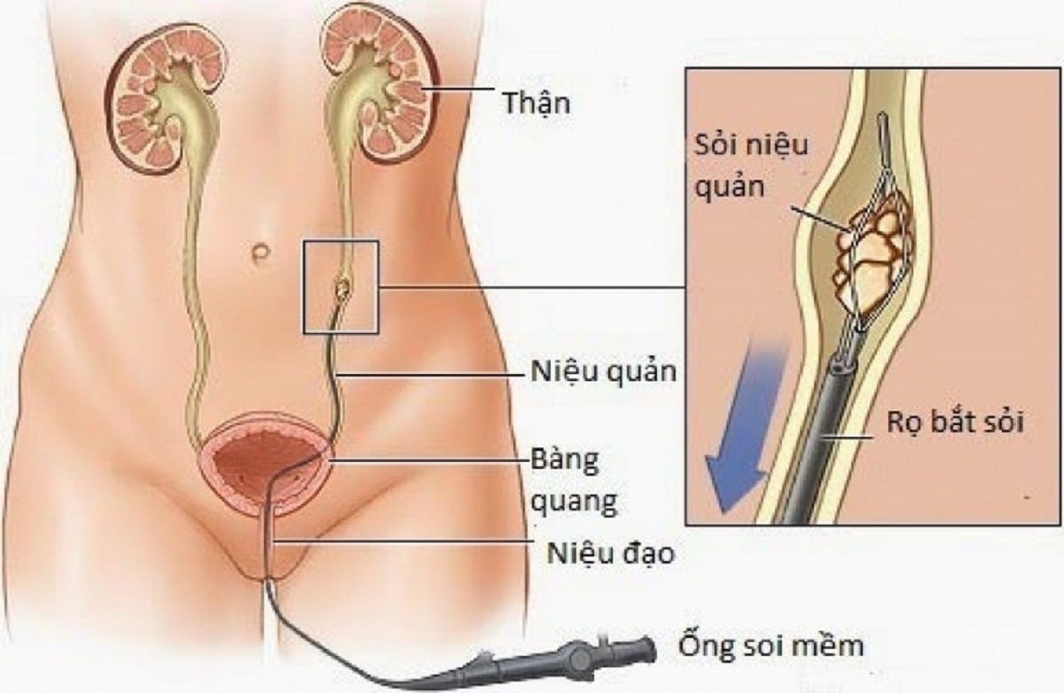 Sau khi tán sỏi, có phải đi tiểu ra máu là triệu chứng thông thường không?