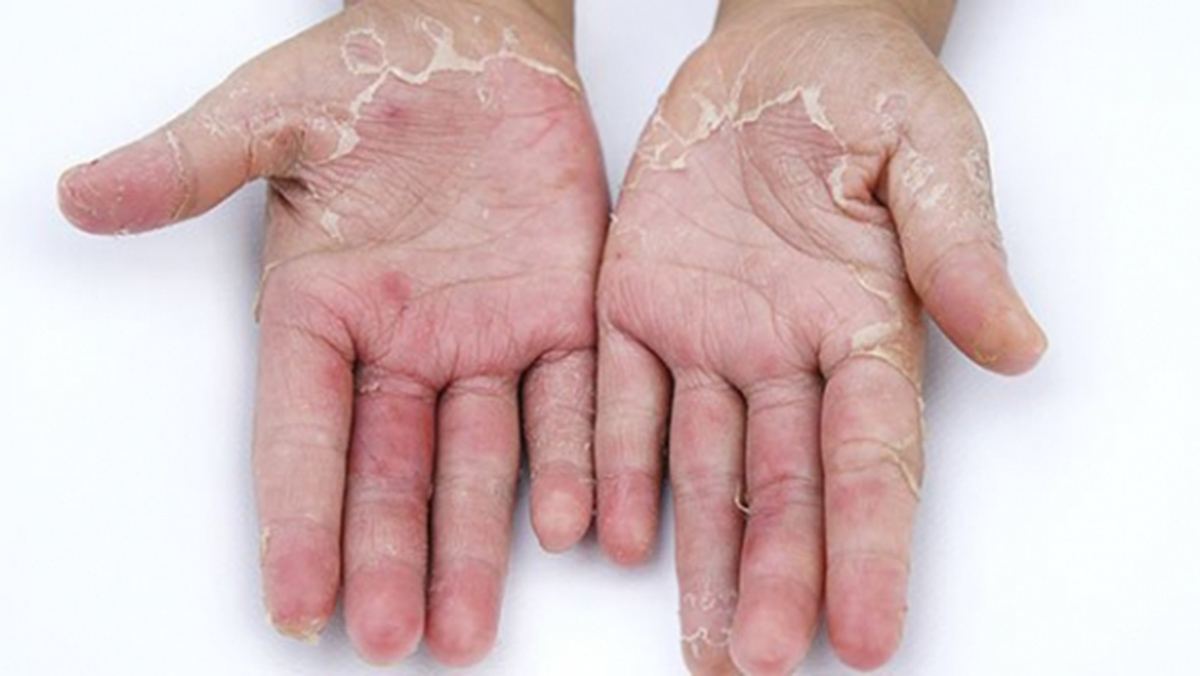 Ngoài thiếu vitamin, nguyên nhân nào khác có thể gây ra tình trạng da tay bị lột?
