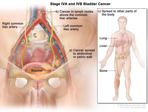 Những triệu chứng nào có thể xuất hiện khi ung thư bàng quang ở giai đoạn cuối gây tắc nghẽn đường tiểu?
