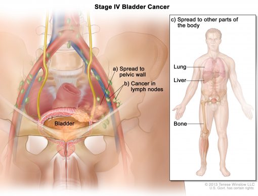 Triệu chứng chính của ung thư bàng quang giai đoạn cuối là gì?
