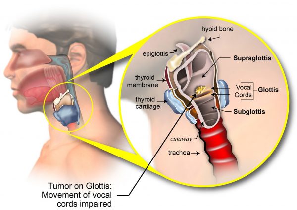 Ung thư thanh quản thường xuất phát từ niêm mạc của dây thanh, nắp thanh nhiệt, băng thanh thất, thanh nhiệt
