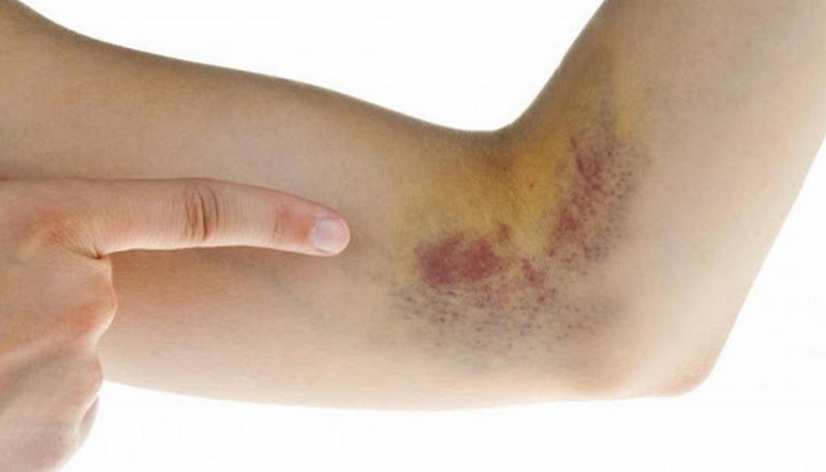 Giải đáp: Xuất huyết dưới da có nguy hiểm không? | TCI Hospital