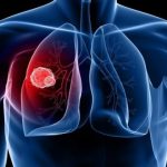 Bệnh u phổi có chữa được không?