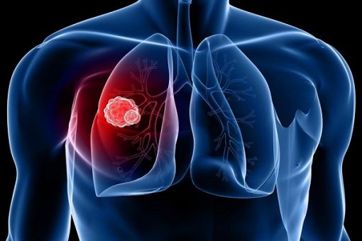 U phổi có thể gây ra những biến chứng gì?
