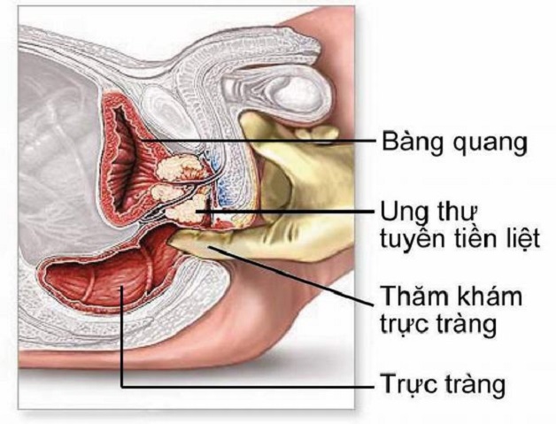 Khám trực tràng như thế nào?