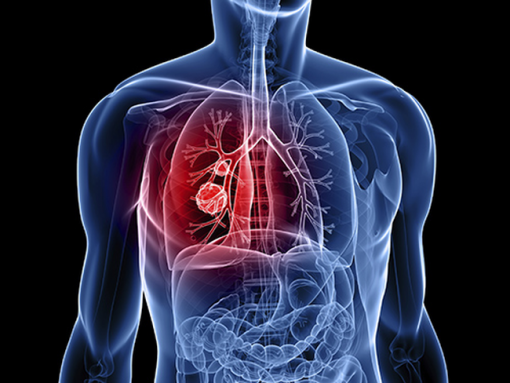Có nguy cơ lây nhiễm ung thư phổi qua việc tiếp xúc với tinh chất hoặc chất lỏng của người mang bệnh không?
