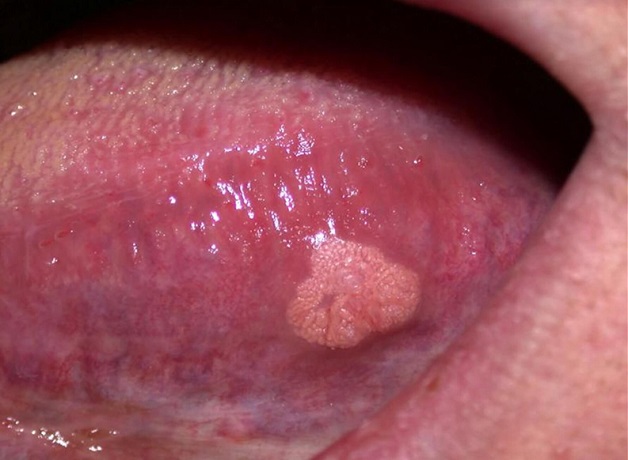 Hình ảnh ung thư lưỡi giai đoạn đầu