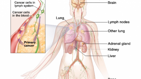 Ung thư phổi di căn gan