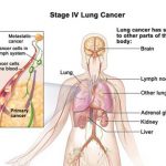 Ung thư phổi di căn xương