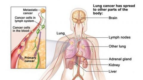 Ung thư phổi di căn xương