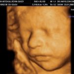 Các mốc siêu âm thai 4D – mẹ bầu cần nhớ