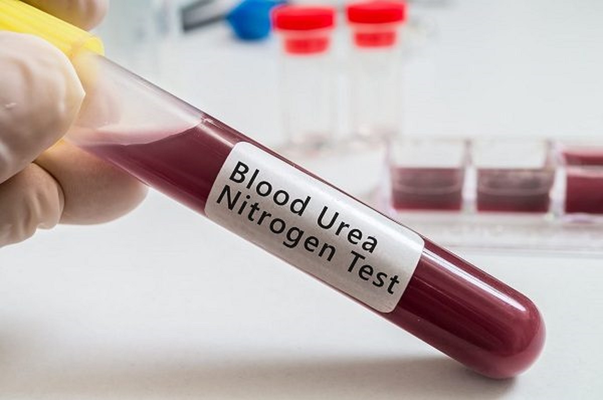 Để xét nghiệm ure máu thấp, bác sĩ sẽ thực hiện những bước xét nghiệm nào?
