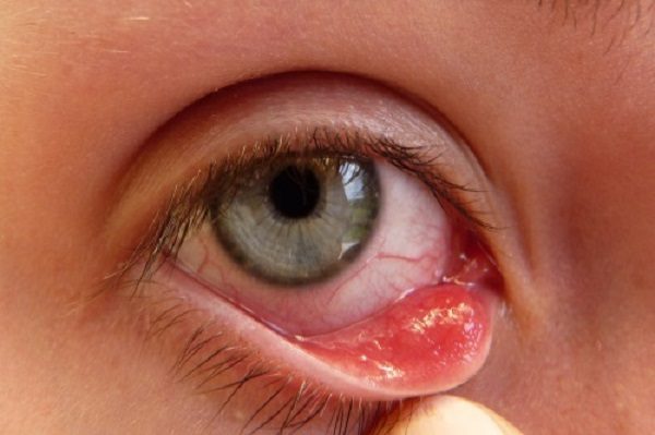 Làm thế nào để phòng tránh bệnh đau mắt hột?